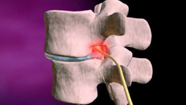 Arthroplastie discale avec prothèse | E-santé - e-sante.be