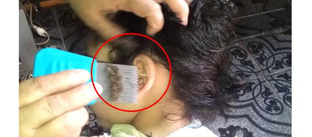 Vídeo mostra uma quantidade impressionante de piolhos (Reprodução - YouTube) Vídeo mostra uma quantidade impressionante de piolhos (Reprodução - YouTube)