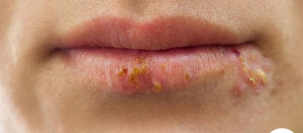 aproximadamente la mitad de los adolescentes y adultos menores de 50 años todavía están infectados con el virus del herpes oral aproximadamente la mitad de los adolescentes y adultos menores de 50 años todavía están infectados con el virus del herpes oral