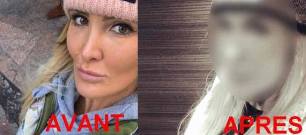 La chirurgie esthétique de trop pour Marie Garet ? La chirurgie esthétique de trop pour Marie Garet ?