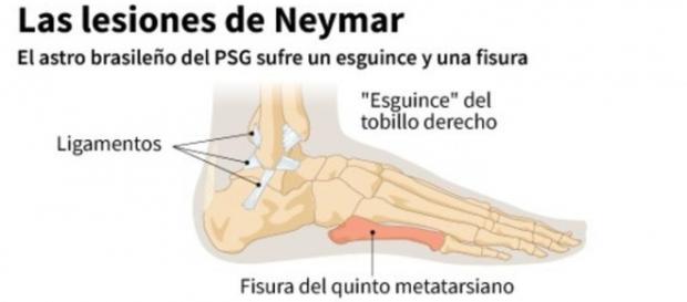 La lesión de Neymar, más grave de lo anunciado La lesión de Neymar, más grave de lo anunciado