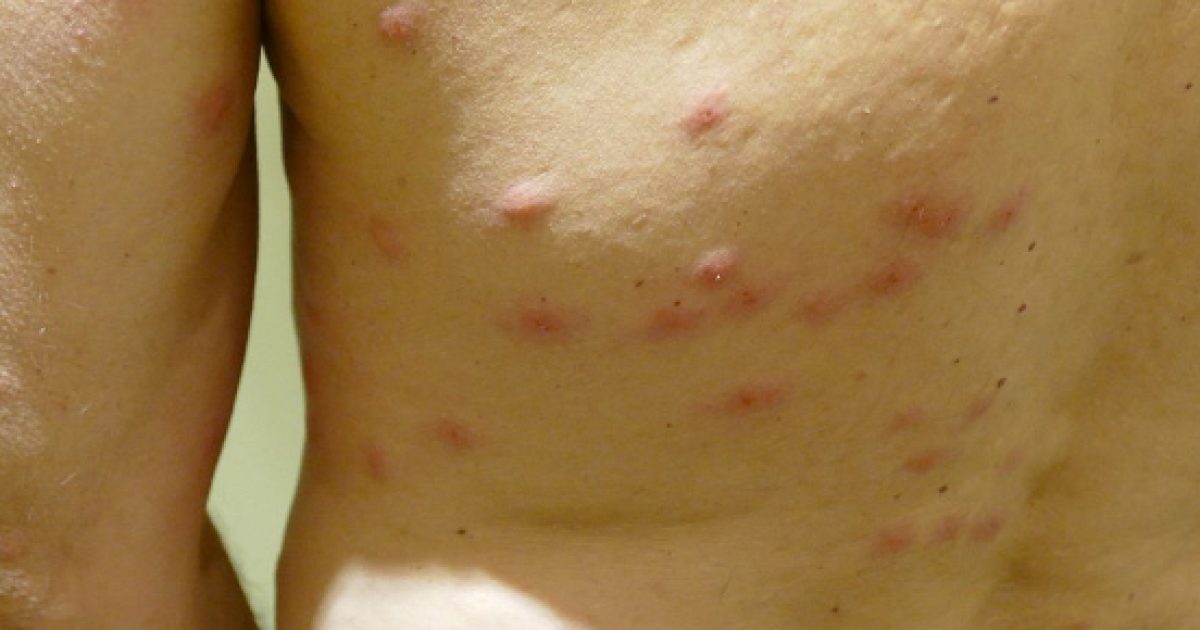 How to identify and treat insect bites and stings in children