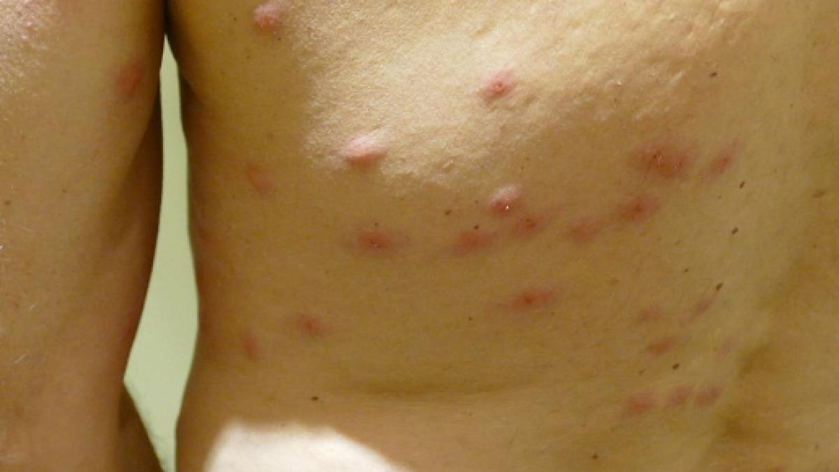How to identify and treat insect bites and in children