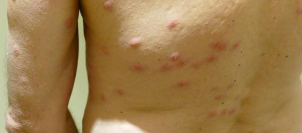 Bed bug bites (Image via Hermann Luyken/Wikimedia) Bed bug bites (Image via Hermann Luyken/Wikimedia)