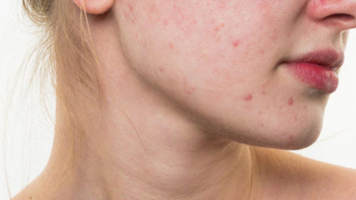 Acne Come Eliminarla Cause 10 Rimedi Naturali Efficaci