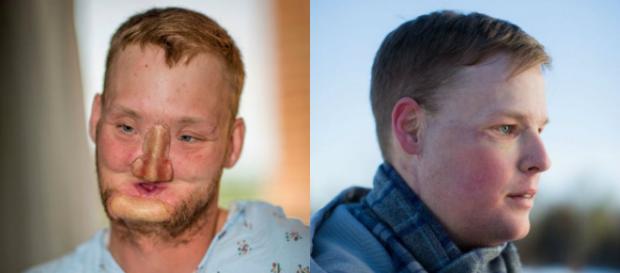 Le hicieron un trasplante de cara y quedó irreconocible | Salud ... - minutouno.com Le hicieron un trasplante de cara y quedó irreconocible | Salud ... - minutouno.com