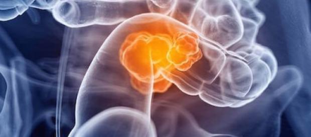 Cáncer colorrectal, más frecuente en jóvenes - vertigopolitico.com Cáncer colorrectal, más frecuente en jóvenes - vertigopolitico.com