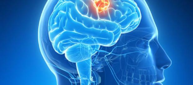 Mecanismo clave en formación de tumores cerebrales | Cáncer ... - com.uy Mecanismo clave en formación de tumores cerebrales | Cáncer ... - com.uy