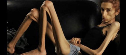 Mujeres con anorexia nerviosa son más propensas a cometer robos ... - com.mx