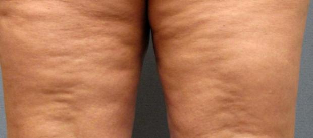Como eliminar, tratar la celulitis - Colaboracion cientifica - colaboracioncientifica.es Como eliminar, tratar la celulitis - Colaboracion cientifica - colaboracioncientifica.es