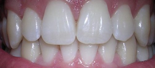 I denti possono auto-ripararsi grazie a una molecola