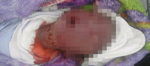 Bebê morre durante parto cesariana