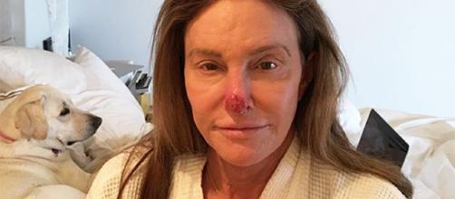 Caitlyn Jenner's skin cancer prevention treatment revealed