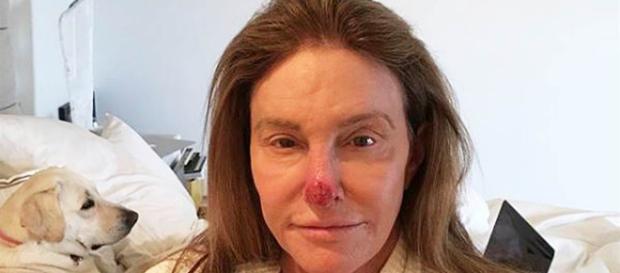 Caitlyn Jenner comparte una foto que muestra el "daño solar ... - celebridadesonline.com Caitlyn Jenner comparte una foto que muestra el "daño solar ... - celebridadesonline.com