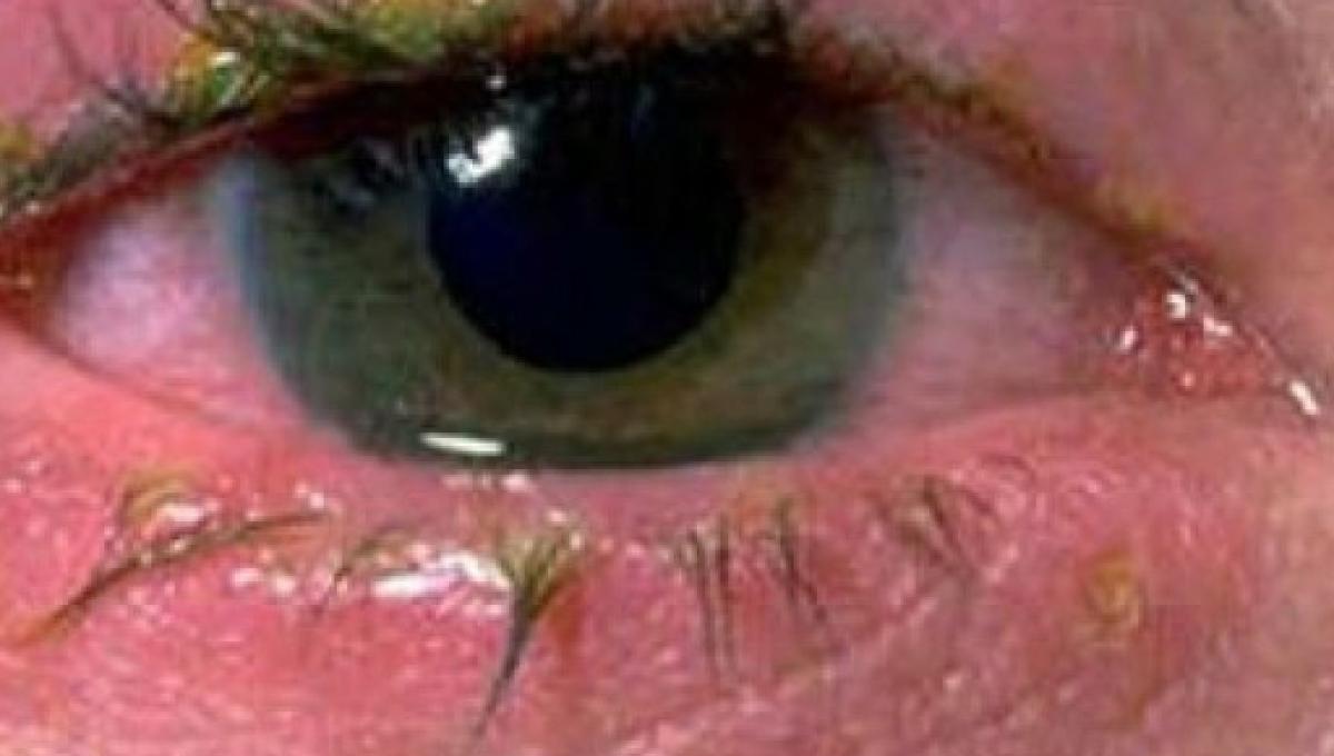 Remedios Caseros Para Infeccion De Ojos En Adultos