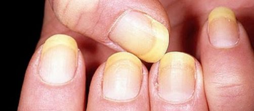 Las uñas amarillentas dan un aspecto muy feo a nuestras manos