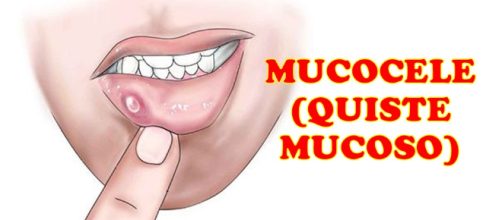 Un quiste mucoso es un saco indoloro y delgado que contiene un líquido claro y que se encuentra sobre la superficie interior de los labios