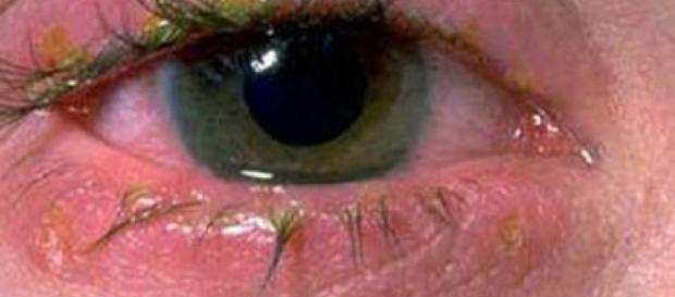 LSi eres propenso a tener conjuntivitis no te pierdas estos remedios naturales para poder aliviar los síntomas LSi eres propenso a tener conjuntivitis no te pierdas estos remedios naturales para poder aliviar los síntomas