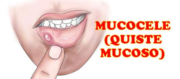 Un quiste mucoso es un saco indoloro y delgado que contiene un líquido claro y que se encuentra sobre la superficie interior de los labios Un quiste mucoso es un saco indoloro y delgado que contiene un líquido claro y que se encuentra sobre la superficie interior de los labios
