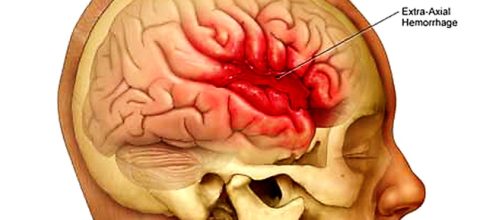 Emorragia cerebrale: cause, sintomi premonitori, diagnosi e cura ... - medicinaonline.co