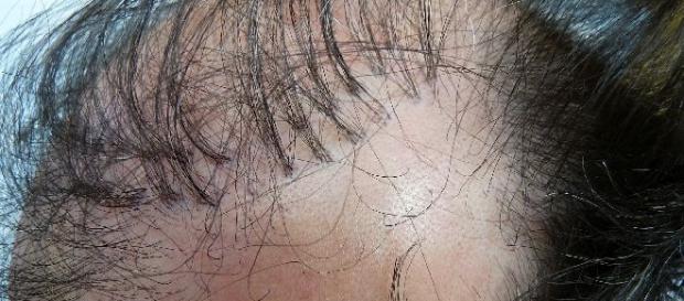 Tufos de cabelo são uma das maiores reclamações dos pacientes que caíram nas clínicas clandestinas Tufos de cabelo são uma das maiores reclamações dos pacientes que caíram nas clínicas clandestinas