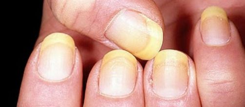 Las uñas, o el cuerpo de la uña, son parte de un estudio dermatológico específico capaz de determinar de antemano el estado de salud