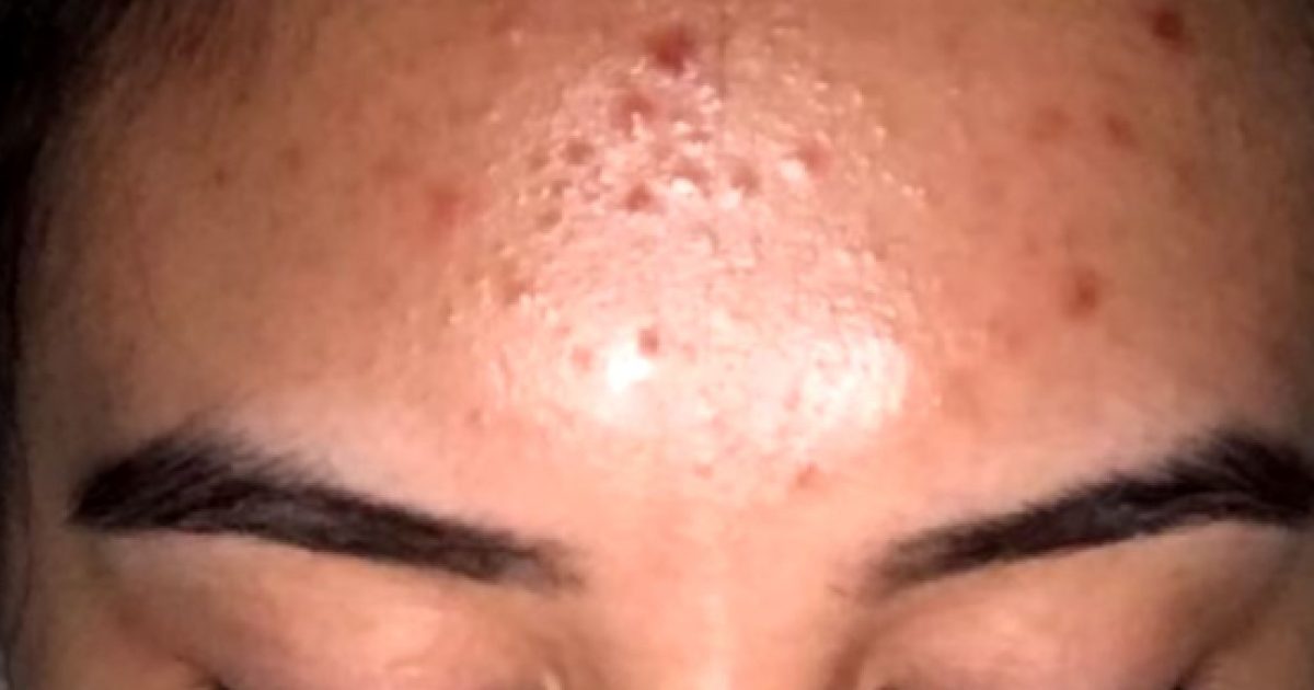 The link between dairy products and acne