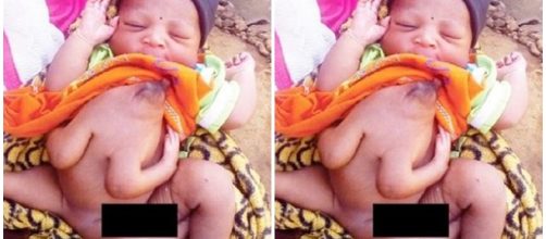 Menina nasce com quatro mãos e três pernas