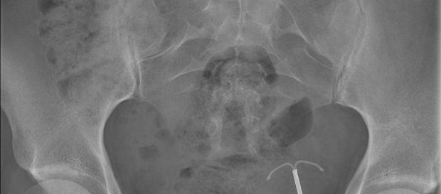 X-ray shows gauze inside a woman's abdomen Mikael Häggström via wikimedia X-ray shows gauze inside a woman's abdomen Mikael Häggström via wikimedia