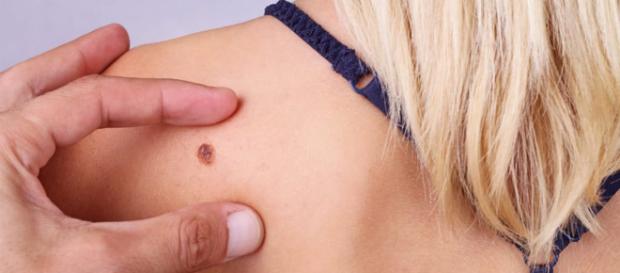 Melanoma: in gravidanza il rischio aumenta - healthgoesup.com Melanoma: in gravidanza il rischio aumenta - healthgoesup.com