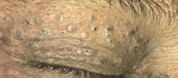 Vídeo mostra dermatologista removendo cravos Vídeo mostra dermatologista removendo cravos