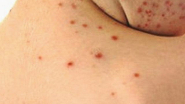 Boom di morbillo in Italia: +230% nei primi mesi del 2017 - Wired - wired.it