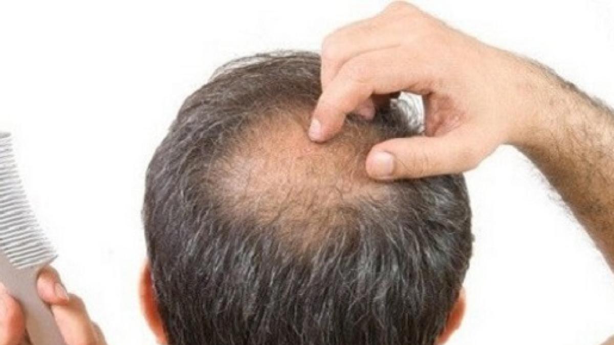 Может ли шампунь спровоцировать выпадение волос