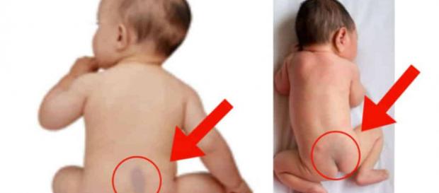 Entenda o que pode ser as manchas escuras no bumbum do bebê Entenda o que pode ser as manchas escuras no bumbum do bebê