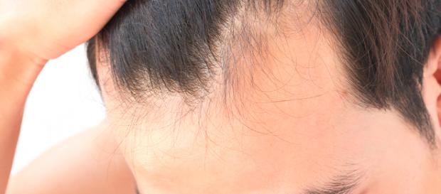 Perdita capelli e calvizie: la scoperta che ridà speranza Perdita capelli e calvizie: la scoperta che ridà speranza