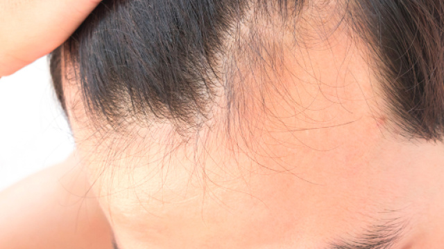 Perdita capelli e calvizie: la scoperta che rid&agrave; speranza