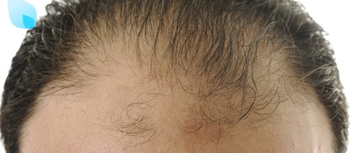 Perdita di capelli e calvizie: la rivelazione di uno studio