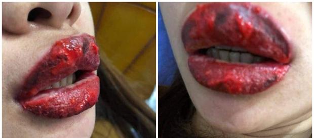 Jovem supostamente fica com lábios inchados após usar batom. Jovem supostamente fica com lábios inchados após usar batom.
