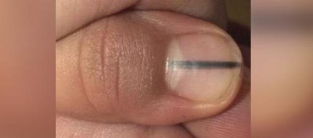 Esse mancha pode ser sinal de um câncer Esse mancha pode ser sinal de um câncer