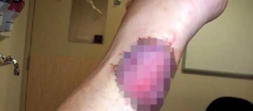Ulcera carnivora: allarme epidemia in Australia per quella che normalmente è una malattia rara - foto:nuovarassegna.it