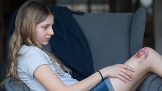 Australia: &egrave; ormai epidemia di ulcera