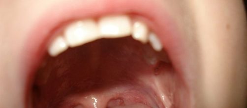 ulceras o aftas en la boca. tipo de tratamiento