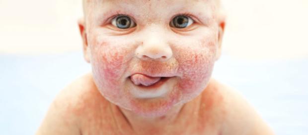 O novo tratamento para dermatite atópica O novo tratamento para dermatite atópica