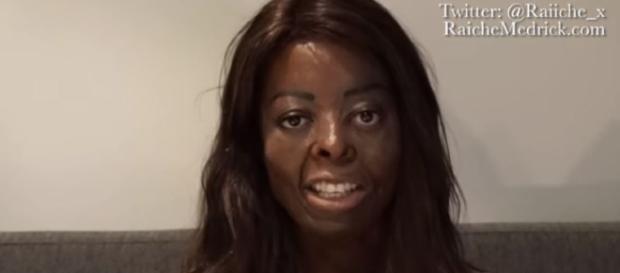 Burn Victim who works so others can feel better about being scarred- Image credit Raiche Mederick | YouTube Burn Victim who works so others can feel better about being scarred- Image credit Raiche Mederick | YouTube
