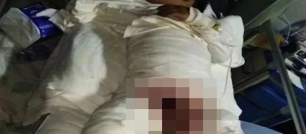 Aluno é queimado por professora Aluno é queimado por professora
