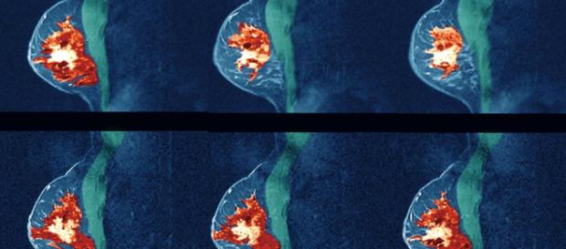 Para algunos pacientes con cáncer de mama, las metástasis tempranas ocurren 12 a 18 meses después de la cirugía Para algunos pacientes con cáncer de mama, las metástasis tempranas ocurren 12 a 18 meses después de la cirugía