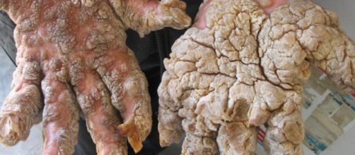 Sindrome dell'uomo pietra: malattia rara che trasforma in 'statue'