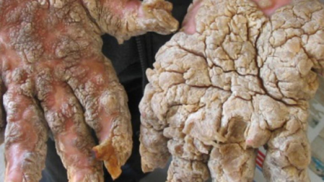 Sindrome dell'uomo pietra: cura sperimentale in arrivo, ecco cosa &egrave; la malattia