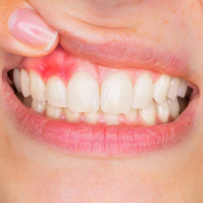 Encías rojas e inflamadas: causas y tratamiento • Clínica Sicilia - clinicasicilia.es