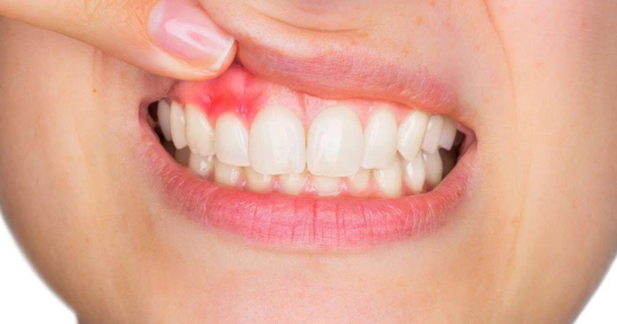 Gingivitis Y Periodontitis:Síntomas Y Tratamiento De La Enfermedad De ...